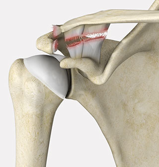 Shoulder Separation  AC Joint Injury Symptoms & Repair