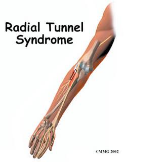 Radial Tunnel Syndrome Stevenage | Tennis Elbow St Albans, Welwyn ...